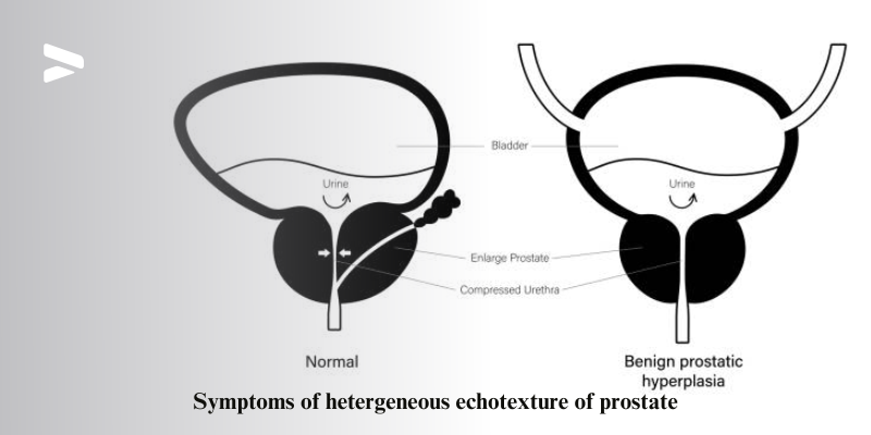 Symptoms of hetergeneous echotexture of prostate