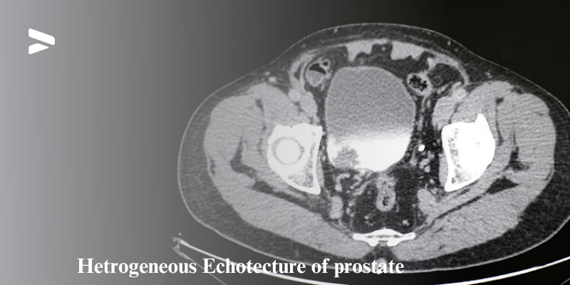 Hetrogeneous Echotecture of prostate